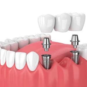 Single and multiple tooth implants