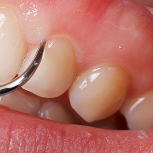 Gum disease