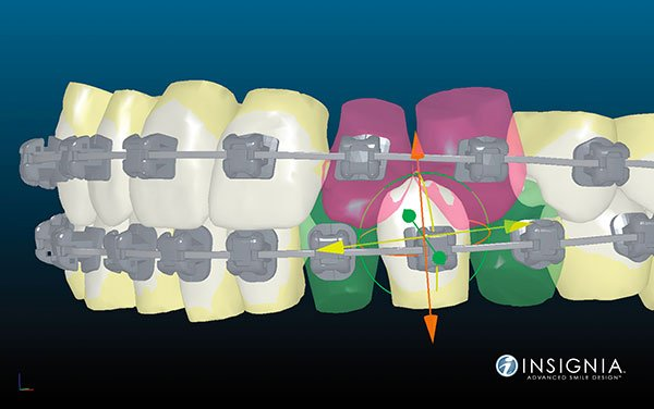 Insignia Custom Braces