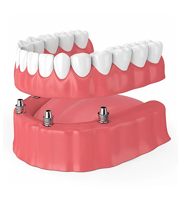 Over Dentures