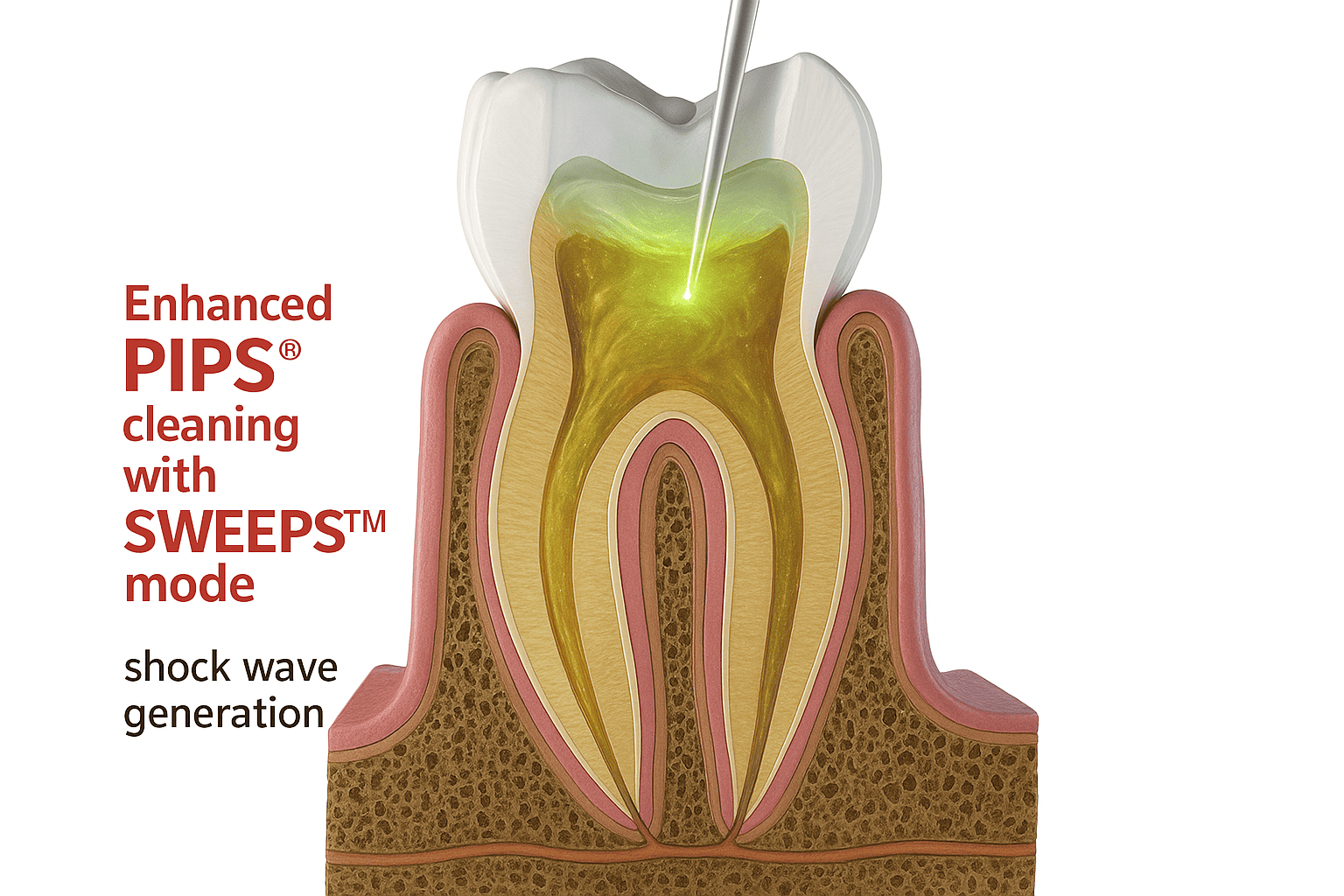 Sweeps Endodontics – Laser assisted Root Canal Therapy