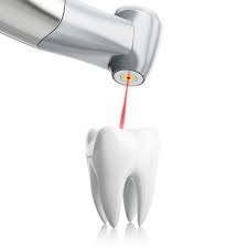 Laser Assisted Dental Fillings