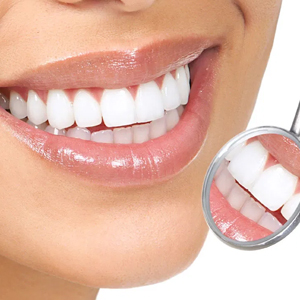 Teeth Whitening